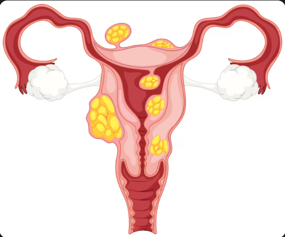 Best PCOS Treatment in Danish Nagar, Bhopal